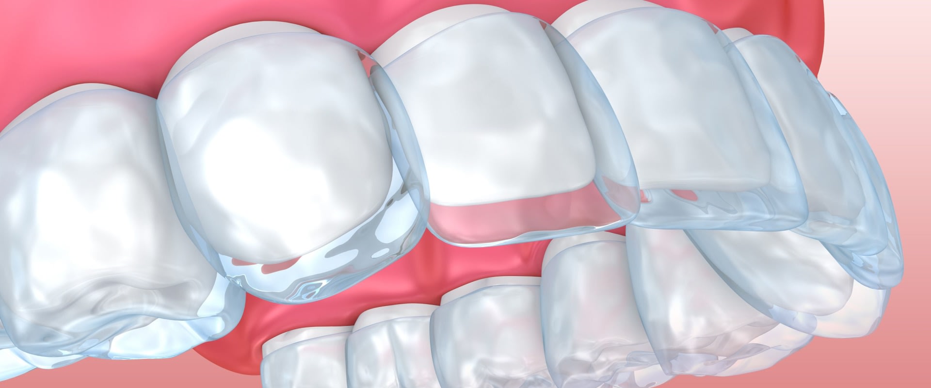 Can Clear Aligners Correct Crowded Teeth?