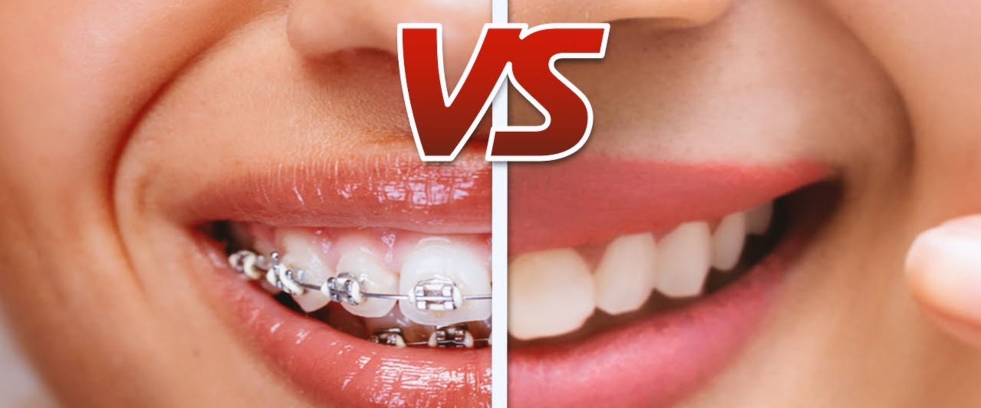 Are aligners cheaper than braces?