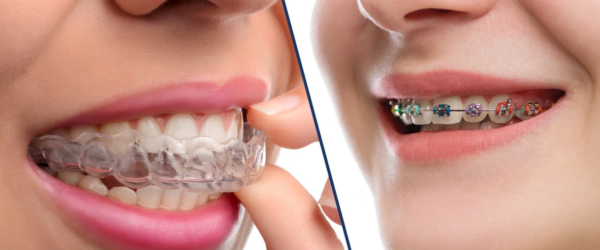 Do aligners take more time than braces?