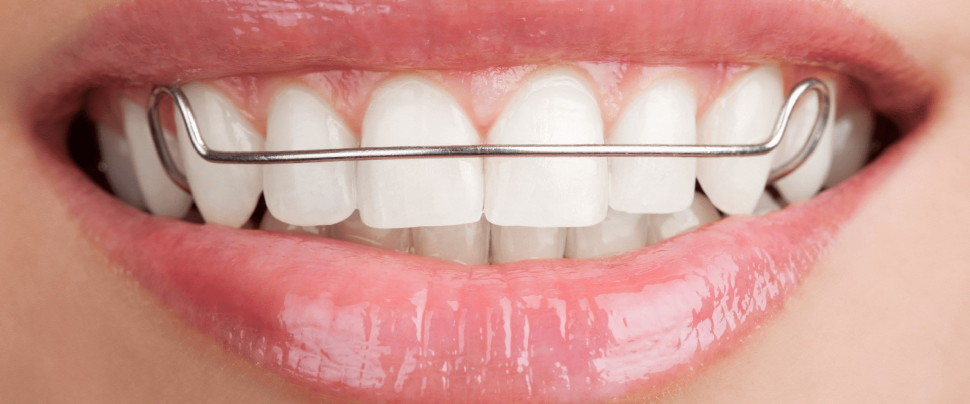 Do you have to wear retainers after clear aligners?