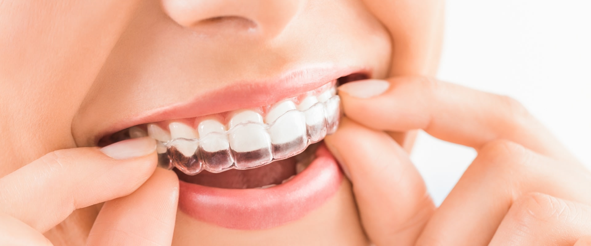 Do Clear Aligners Work as Well as Braces?