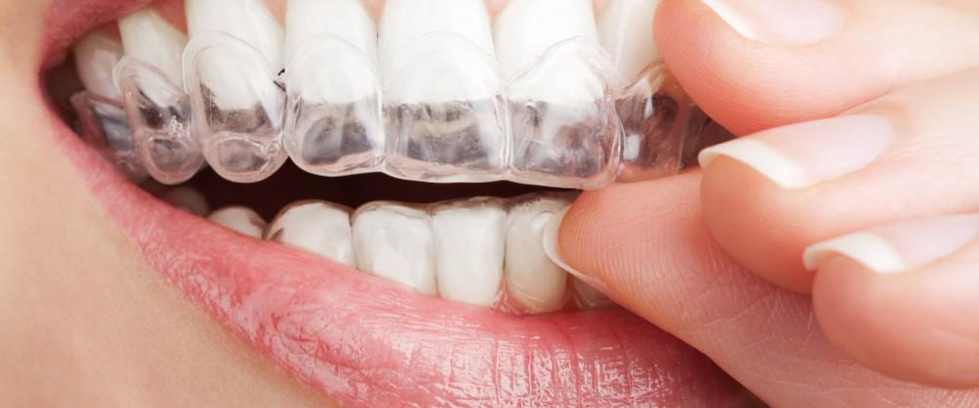 Can Clear Aligners Cause Cavities? An Expert's Perspective