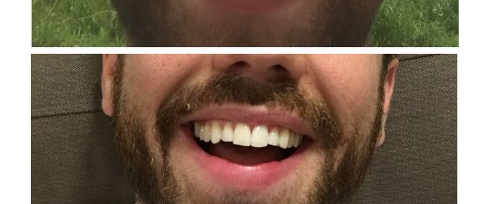 Clear Aligners UK: A Comprehensive Review