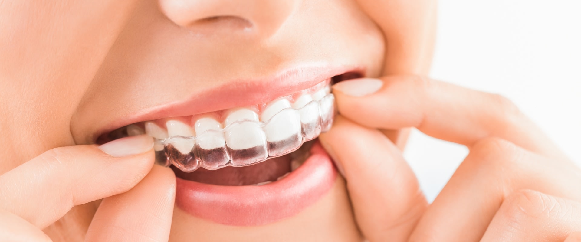 How Long Does It Take for Clear Aligners to Work?