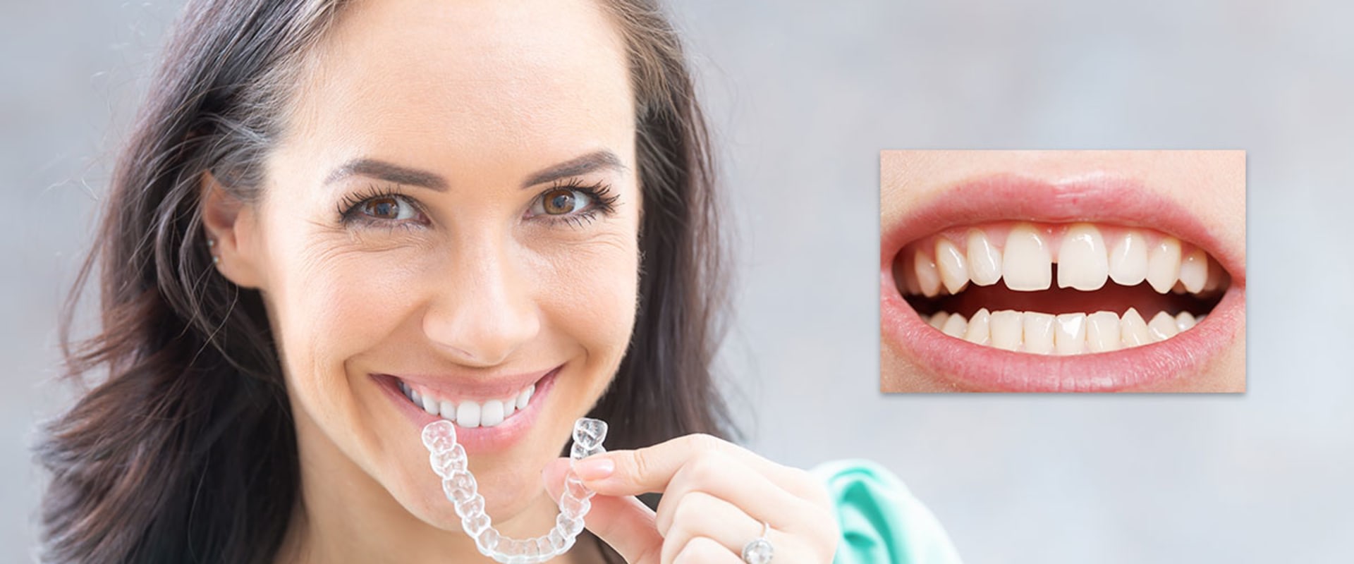 Can Clear Aligners Fix Gaps? A Comprehensive Guide