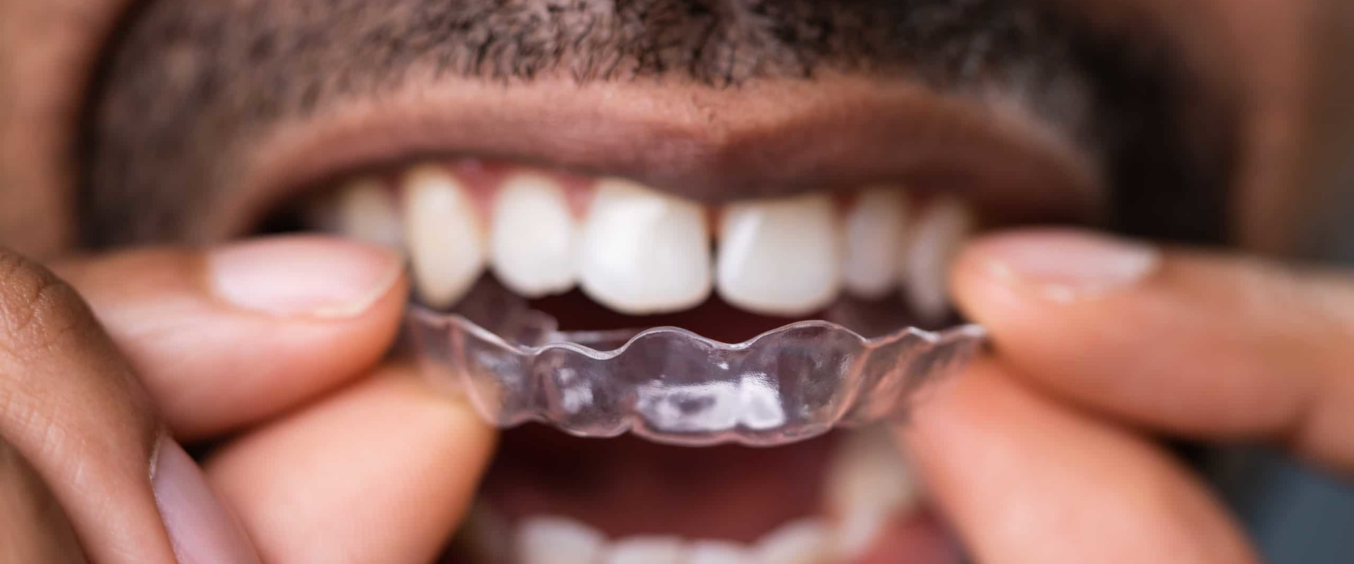 Are Clear Aligners the Best Option for Your Teeth?