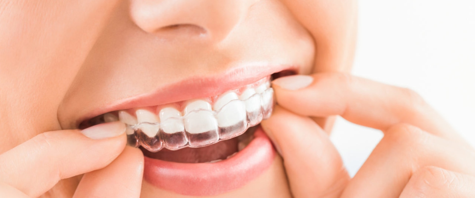 How Long Does it Take to Straighten Teeth with Spark Clear Aligners?