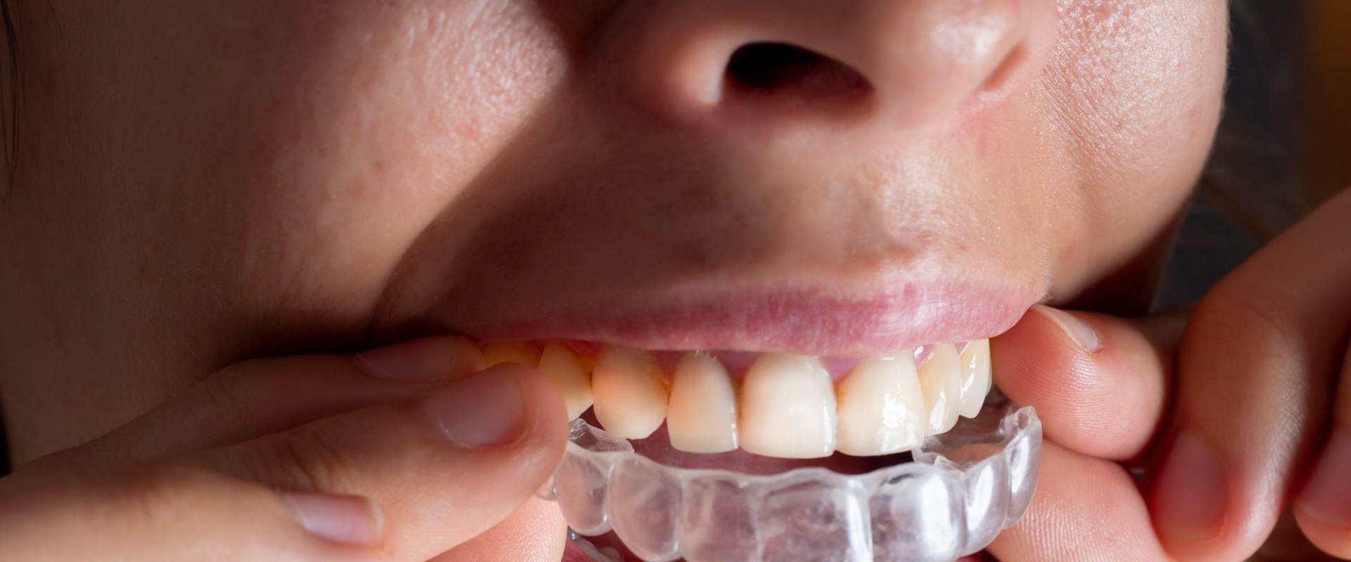 Which Clear Aligners are the Cheapest?