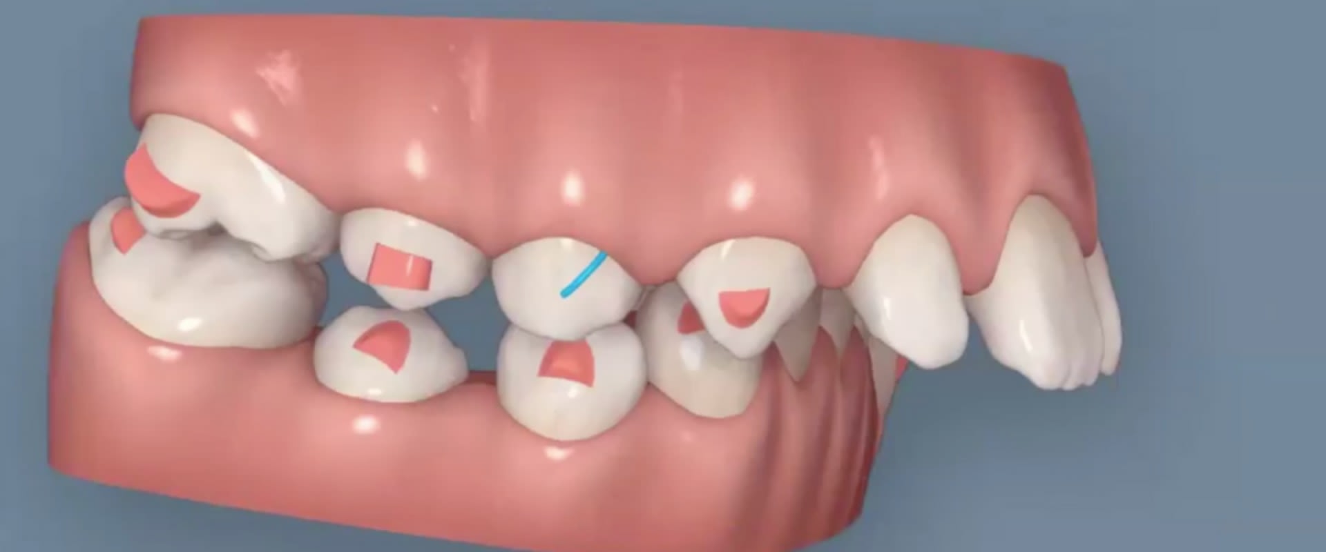 Do Clear Aligners Work Faster Than Braces?