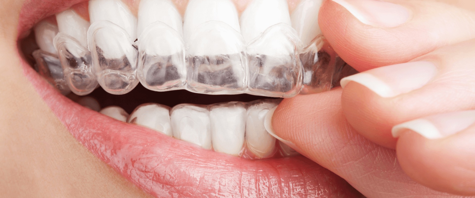 Are Clear Aligners Safe? An Expert's Perspective