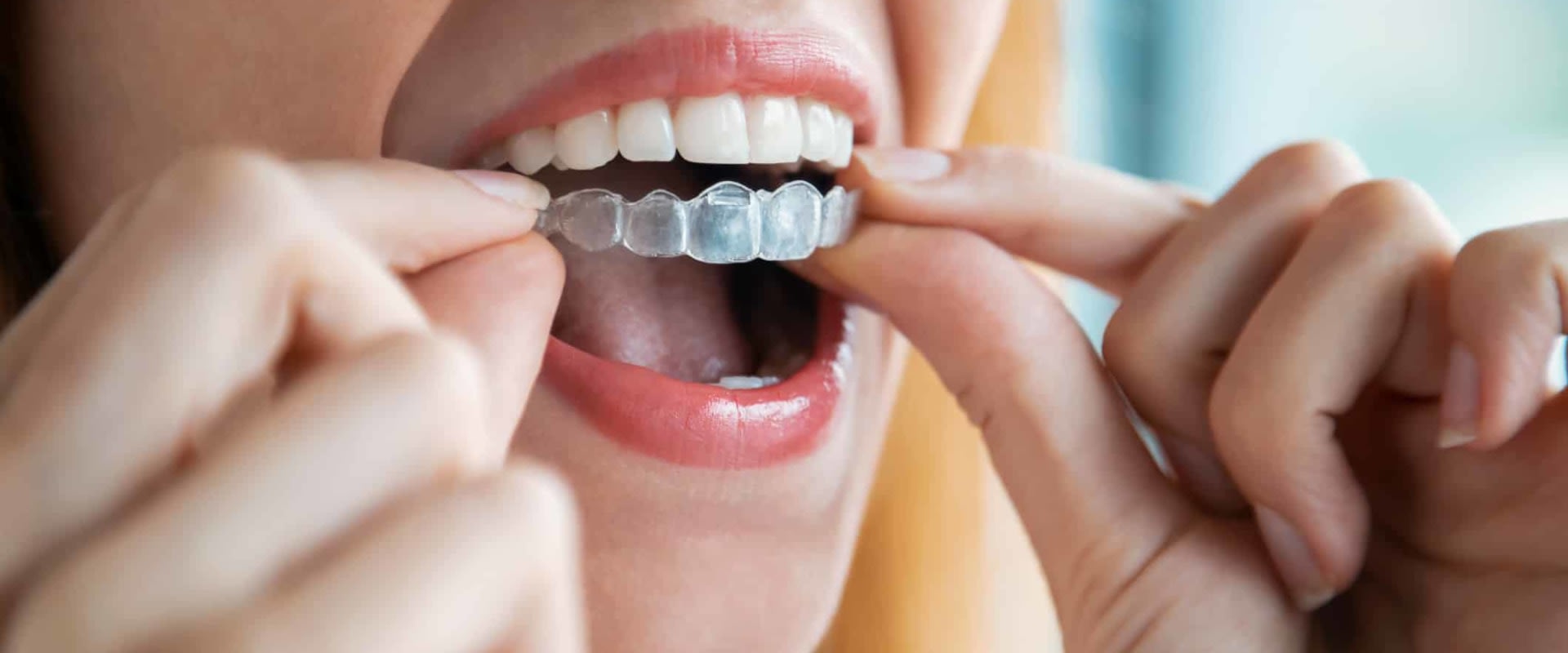 What are Spark Clear Aligners and How Can They Help You?