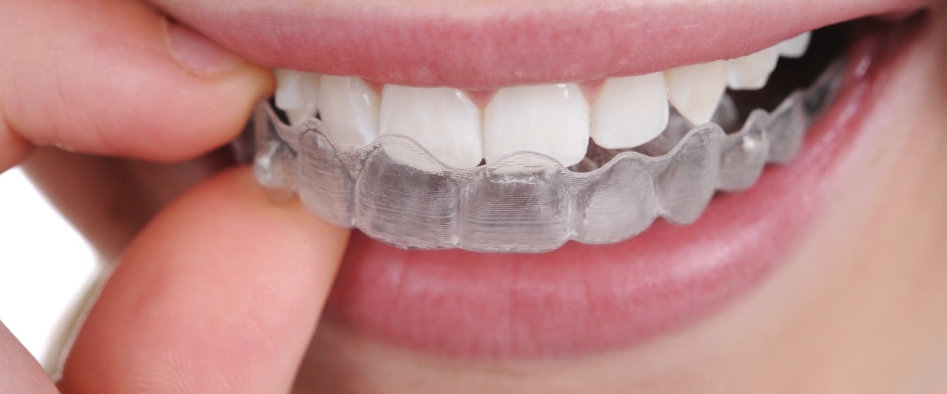 Are Clear Teeth Aligners Safe and Effective?