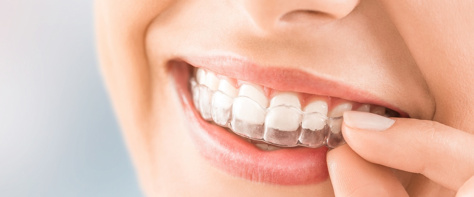 Can Clear Aligners Give You a Perfect Smile?