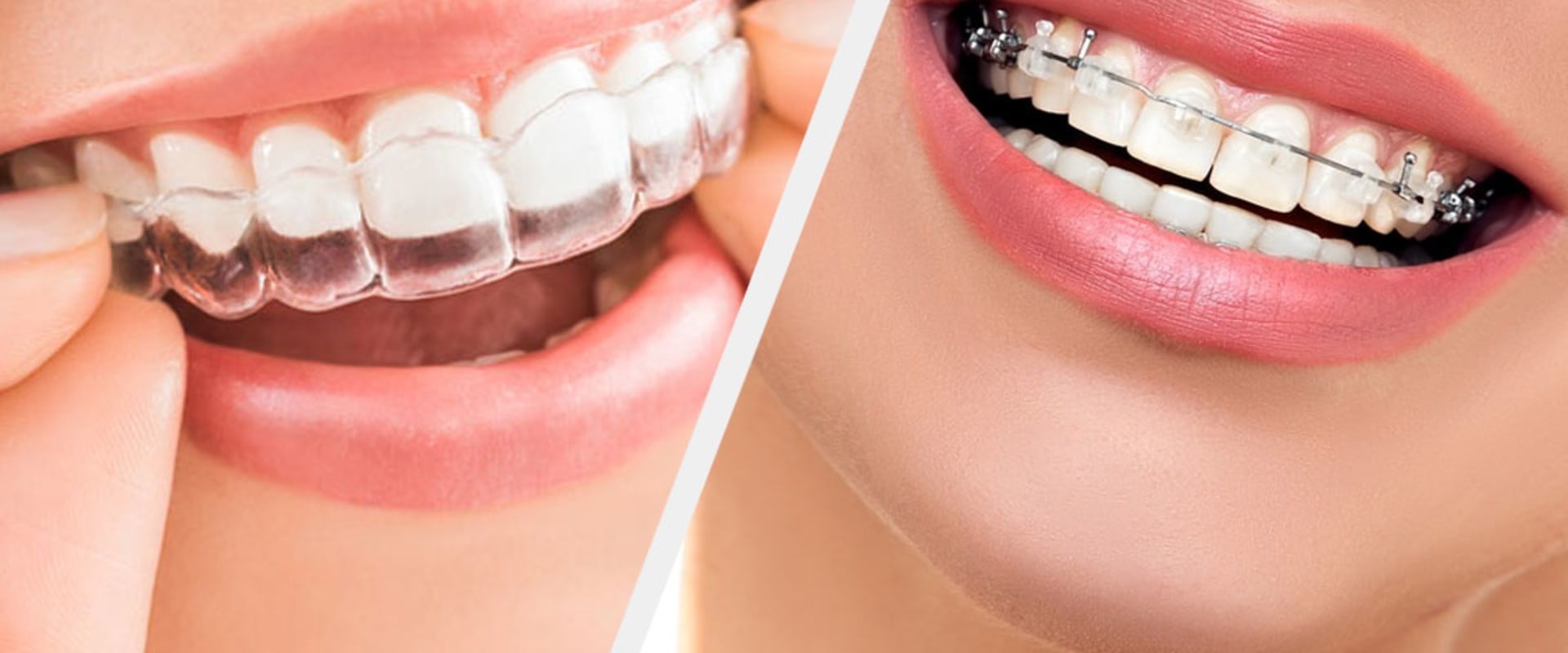 Are Clear Aligners More Expensive Than Braces?