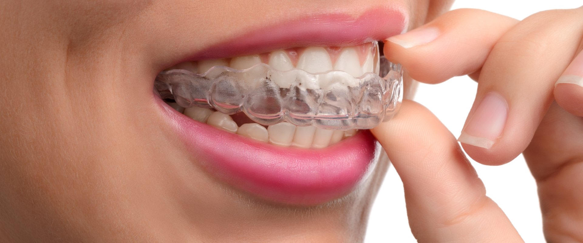 Can Clear Aligners Straighten Teeth?