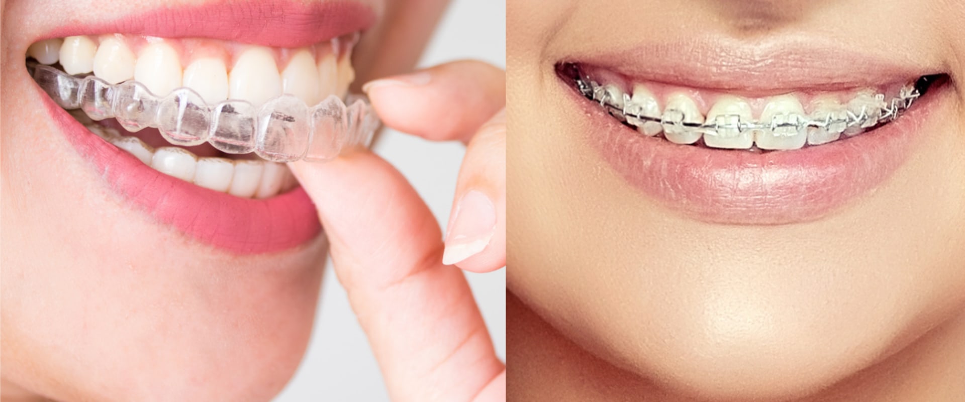 Are Clear Aligners Noticeable? An Expert's Perspective