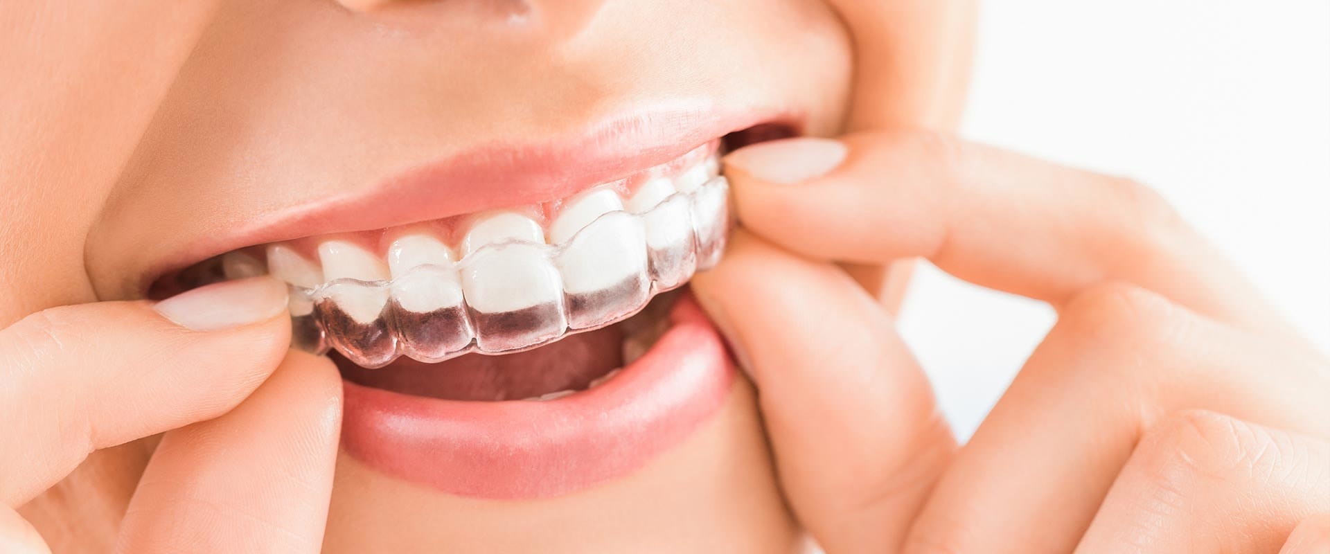 Do Clear Aligners Work Faster Than Braces?