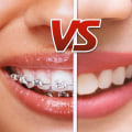 Are aligners cheaper than braces?
