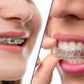 Do aligners take more time than braces?