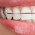 Do you have to wear retainers after clear aligners?