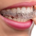 How Long Does it Take for Clear Aligners to Work?