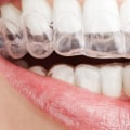 Can Clear Aligners Cause Cavities? An Expert's Perspective