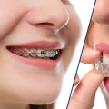 Comparing Clear Aligners and Invisalign: What's the Difference?