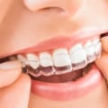 Everything You Need to Know About Clear Aligners for Teeth