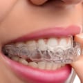 Are Clear Aligners Faster Than Braces?