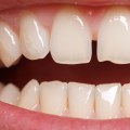 Can Clear Aligners Fix Gaps in Front Teeth?