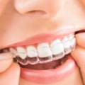 How Long Does it Take to Straighten Teeth with Spark Clear Aligners?