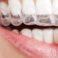 Do Invisible Aligners Really Work?