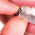 Do Clear Aligners Work as Well as Braces?