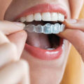 What are Spark Clear Aligners and How Can They Help You?