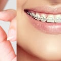 Are Clear Aligners Really the Same?