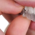 Are Clear Teeth Aligners Safe and Effective?