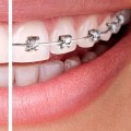 How Long Does Invisalign Take to Straighten Teeth?