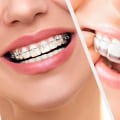 Why do aligners work faster than braces?