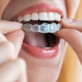 How Much Does it Cost to Get Spark Clear Aligners?