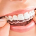 Do Clear Aligners Work Faster Than Braces?