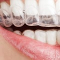 Can Clear Aligners Fix Teeth Permanently?