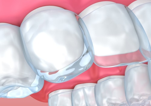 Can Clear Aligners Correct Crowded Teeth?