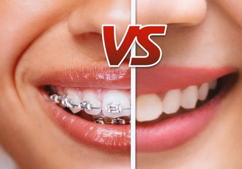 Are aligners cheaper than braces?