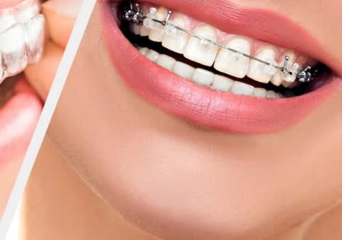 Which Clear Teeth Aligners are the Best Choice?