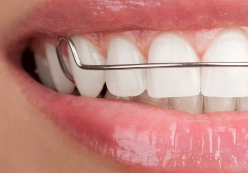 Do you have to wear retainers after clear aligners?