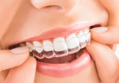 Do Clear Aligners Work as Well as Braces?