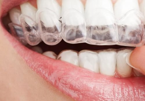 Can Clear Aligners Cause Cavities? An Expert's Perspective