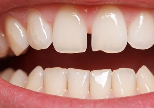 Can Clear Aligners Fix Gaps in Front Teeth?