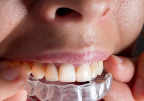 Are Aligners Cheaper Than Braces?