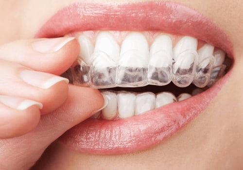 Are Clear Aligners Safe? An Expert's Perspective